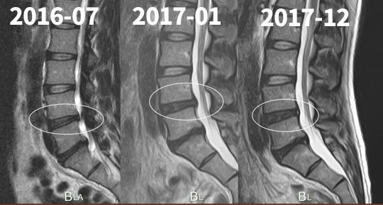 腰痛と首のmri撮影した費用と5枚の経過画像と日々の体操メニュー