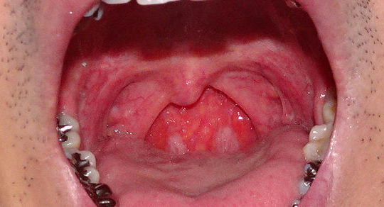 喉の腫れ２